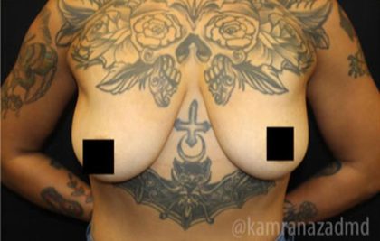 Breast Lift Before & After Patient #2296