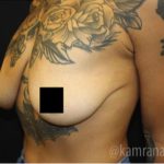 Breast Lift Before & After Patient #2296
