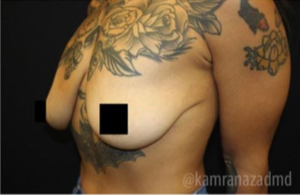 Breast Lift Before & After Patient #2296