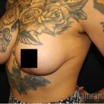Breast Lift Before & After Patient #2296