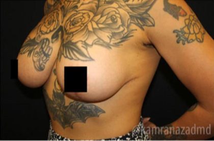 Breast Lift Before & After Patient #2296