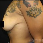 Breast Lift Before & After Patient #2296