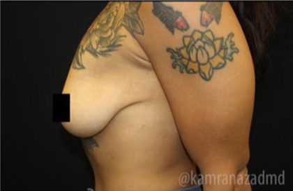Breast Lift Before & After Patient #2296
