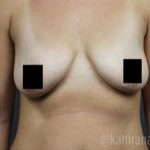 Breast Lift Before & After Patient #2297