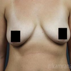 Breast Lift Before & After Patient #2297