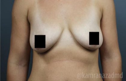 Breast Lift Before & After Patient #2297