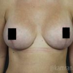 Breast Lift Before & After Patient #2297