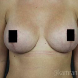 Breast Lift Before & After Patient #2297