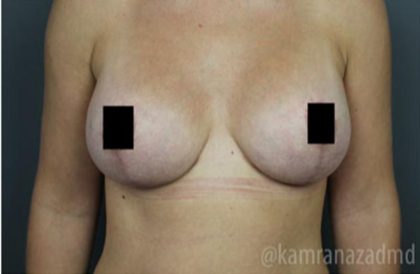 Breast Lift Before & After Patient #2297