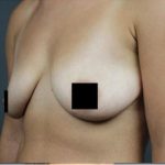 Breast Lift Before & After Patient #2297