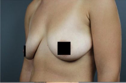 Breast Lift Before & After Patient #2297