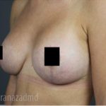 Breast Lift Before & After Patient #2297
