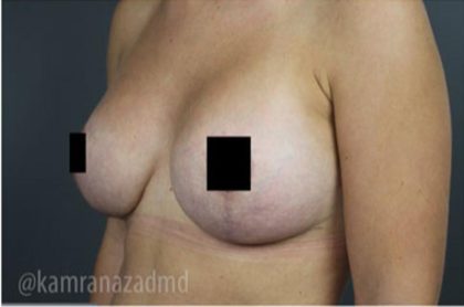 Breast Lift Before & After Patient #2297
