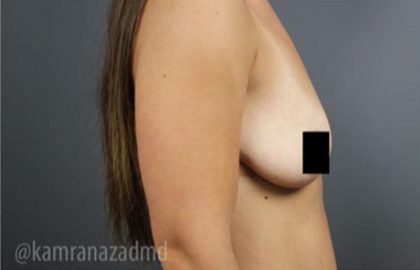 Breast Lift Before & After Patient #2297