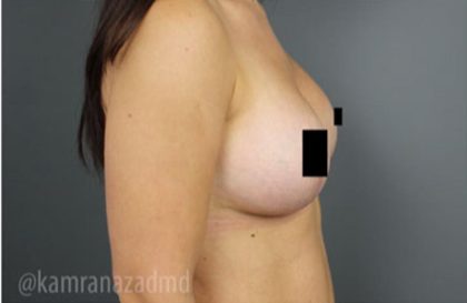 Breast Lift Before & After Patient #2297