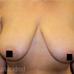 Breast Lift Before & After Patient #2279