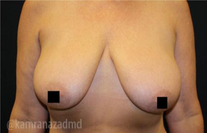 Breast Lift Before & After Patient #2279