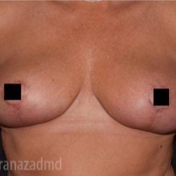 Breast Lift Before & After Patient #2279