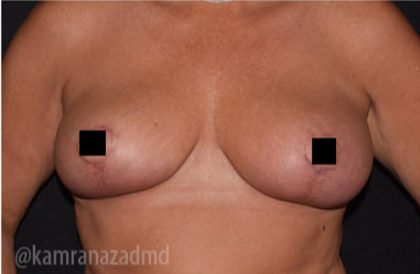 Breast Lift Before & After Patient #2279
