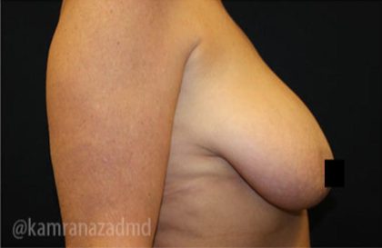 Breast Lift Before & After Patient #2279