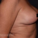 Breast Lift Before & After Patient #2279