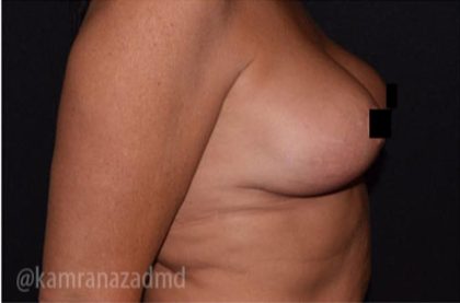 Breast Lift Before & After Patient #2279