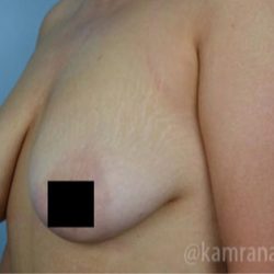Breast Lift Before & After Patient #2298