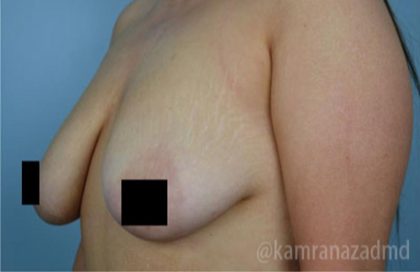 Breast Lift Before & After Patient #2298