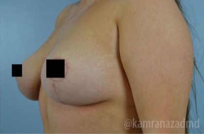 Breast Lift Before & After Patient #2298