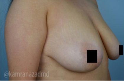 Breast Lift Before & After Patient #2298