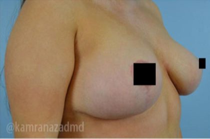 Breast Lift Before & After Patient #2298