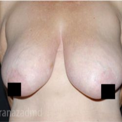 Breast Lift Before & After Patient #2299