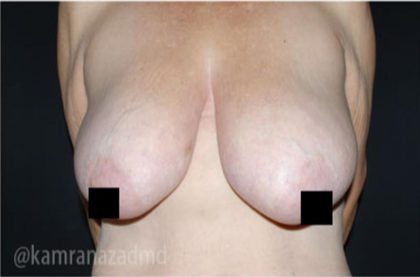 Breast Lift Before & After Patient #2299