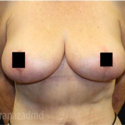 Breast Lift Before & After Patient #2299