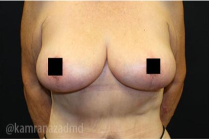 Breast Lift Before & After Patient #2299