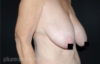 Breast Lift Before & After Patient #2299