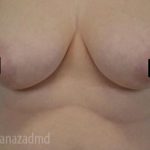 Breast Lift Before & After Patient #2280