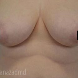 Breast Lift Before & After Patient #2280