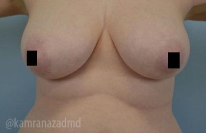 Breast Lift Before & After Patient #2280