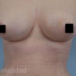 Breast Lift Before & After Patient #2280
