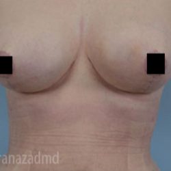 Breast Lift Before & After Patient #2280
