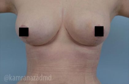 Breast Lift Before & After Patient #2280
