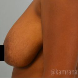 Breast Lift Before & After Patient #2281