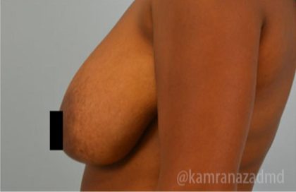 Breast Lift Before & After Patient #2281