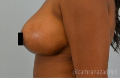 Breast Lift Before & After Patient #2281