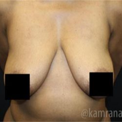 Breast Lift Before & After Patient #2282