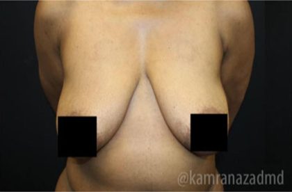 Breast Lift Before & After Patient #2282