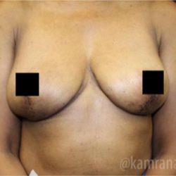Breast Lift Before & After Patient #2282