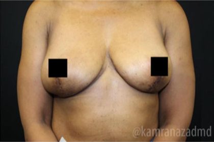 Breast Lift Before & After Patient #2282