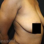 Breast Lift Before & After Patient #2282